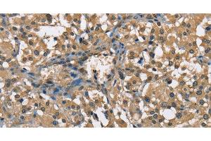 Immunohistochemistry of paraffin-embedded Human thyroid cancer using ENO1 Polyclonal Antibody at dilution of 1:60 (ENO1 抗体)