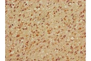 Immunohistochemistry of paraffin-embedded human glioma using ABIN7159613 at dilution of 1:100 (MBD3 抗体  (AA 79-209))
