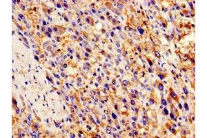 Immunohistochemistry of paraffin-embedded human liver cancer using ABIN7145972 at dilution of 1:100