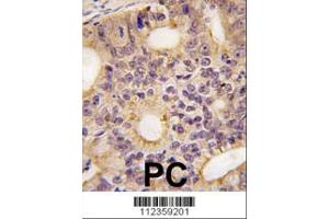 Formalin-fixed and paraffin-embedded human prostata carcinoma tissue reacted with Latexin antibody (N-term), which was peroxidase-conjugated to the secondary antibody, followed by DAB staining. (Latexin 抗体  (N-Term))