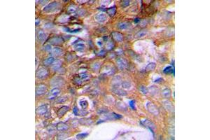 Immunohistochemical analysis of HIBADH staining in human prostate cancer formalin fixed paraffin embedded tissue section. (HIBADH 抗体  (C-Term))