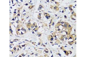 Immunohistochemistry of paraffin-embedded Human breast cancer using CAMLG Polyclonal Antibody at dilution of 1:100 (40x lens). (CAMLG 抗体)