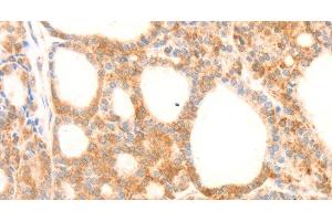 Immunohistochemistry of paraffin-embedded Human thyroid cancer using NAP1L1 Polyclonal Antibody at dilution of 1:70 (NAP1L1 抗体)
