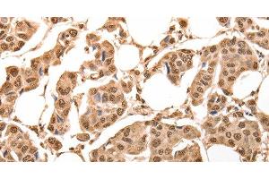 Immunohistochemistry of paraffin-embedded Human breast cancer using ACO2 Polyclonal Antibody at dilution of 1:30 (ACO2 抗体)