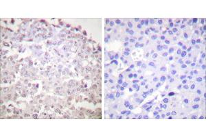 Peptide - +Immunohistochemical analysis of paraffin-embedded human breast carcinoma tissue using GADD153 antibody (#C0202). (DDIT3 抗体)