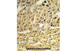 Formalin-fixed and paraffin-embedded human hepatocarcinoma reacted with EED Antibody (Center), which was peroxidase-conjugated to the secondary antibody, followed by DAB staining. (CCNB1IP1 抗体  (C-Term))