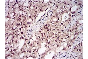 Immunohistochemical analysis of paraffin-embedded cervical cancer tissues using PPP1CB mouse mAb with DAB staining. (PPP1CB 抗体  (AA 174-327))