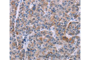 Immunohistochemistry of Human liver cancer using KRT14 Polyclonal Antibody at dilution of 1:20 (KRT14 抗体)