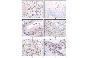 Immunohistochemical analysis of paraffin-embedded human esophageal squamous cell carcinoma (A), normal esophagus epithelium (B), rectum adenocarcinoma (C), lung squamous cell carcinoma (D), breast infiltrating carcinoma (E), and breast infiltrating carcinoma (F) tissues, showing nuclear localization using MOF/MYST1 mouse mAb with DAB staining. (MYST1 抗体)