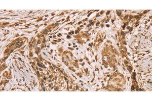 Immunohistochemistry of paraffin-embedded Human esophagus cancer using HIF1AN Polyclonal Antibody at dilution of 1:40 (HIF1AN 抗体)
