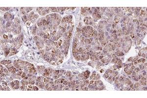 ABIN6273249 at 1/100 staining Human pancreas cancer tissue by IHC-P. (GMFG 抗体  (Internal Region))