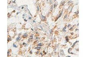Immunohistochemical analysis of paraffin-embedded human lung carcinoma showing cytoplasmic staining with AARSD1 polyclonal antibody  at a 1 : 100 dilution. (AARSD1 抗体  (AA 278-522))