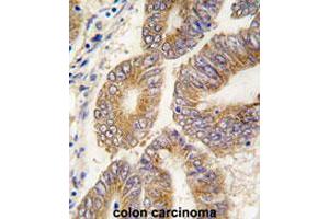 Formalin-fixed and paraffin-embedded human colon carcinomareacted with AHCY polyclonal antibody , which was peroxidase-conjugated to the secondary antibody, followed by AEC staining. (AHCY 抗体  (C-Term))