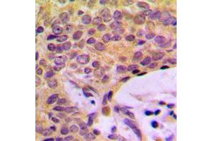 Immunohistochemical analysis of CCP2 staining in human breast cancer formalin fixed paraffin embedded tissue section. (AGBL2 抗体  (C-Term))