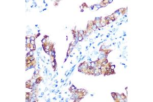 Immunohistochemistry of paraffin-embedded human oophoroma using IMP3 Rabbit mAb (ABIN7267904) at dilution of 1:100 (40x lens). (IGF2BP3 抗体)