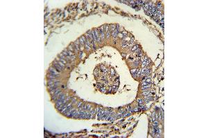 CALR Antibody (ABIN652259 and ABIN2841097) immunohistochemistry analysis in formalin fixed and paraffin embedded human colon carcinoma followed by peroxidase conjugation of the secondary antibody and DAB staining. (Calreticulin 抗体)
