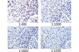 Immunohistochemistry of paraffin-embedded human esophageal cancer using Lamin A/C antibody (ABIN7268177) at dilution of 1:400 - 1:3200 (40x lens). (Lamin A/C 抗体)