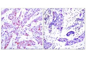 Immunohistochemical analysis of human paraffin-embedded human breast carcinoma tissue using ATF4 (Ab-245) antibody (E021053). (ATF4 抗体)