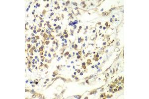 Immunohistochemistry of paraffin-embedded human liver cancer using UPF1 antibody at dilution of 1:100 (x40 lens). (RENT1/UPF1 抗体)