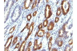 Formalin-fixed, paraffin-embedded human Gastric Carcinoma stained with MUC6 Monoclonal Antibody (MUC6/916). (MUC6 抗体)
