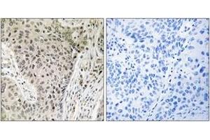 Immunohistochemistry analysis of paraffin-embedded human lung carcinoma, using ARHGEF19 Antibody. (ARHGEF19 抗体  (AA 251-300))