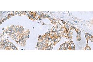 Immunohistochemistry of paraffin-embedded Human gastric cancer tissue using MGME1 Polyclonal Antibody at dilution of 1:70(x200) (C20orf72 抗体)