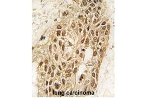 Formalin-fixed and paraffin-embedded human lung carcinoma tissue reacted with Dnmt3a antibody (N-term R46) (ABIN387883 and ABIN2844094) , which was peroxidase-conjugated to the secondary antibody, followed by DAB staining. (DNMT3A 抗体  (N-Term))