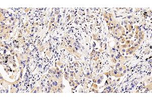 Detection of IL5Ra in Human Lung cancer Tissue using Polyclonal Antibody to Interleukin 5 Receptor Alpha (IL5Ra) (IL5RA 抗体  (AA 42-182))