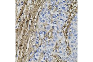 Immunohistochemistry of paraffin-embedded human prostate cancer using COL1A1 antibody. (COL1A1 抗体)