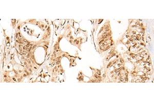 Immunohistochemistry of paraffin-embedded Human colorectal cancer tissue using ARID1B Polyclonal Antibody at dilution of 1:40(x200) (ARID1B 抗体)