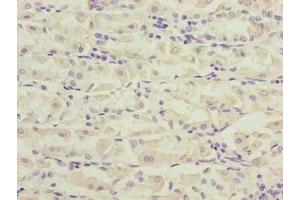 Immunohistochemistry of paraffin-embedded human gastric cancer using ABIN7162519 at dilution of 1:100 (PILRB 抗体  (AA 20-191))