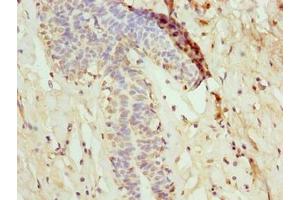 Immunohistochemistry of paraffin-embedded human breast cancer using ABIN7160728 at dilution of 1:100 (NANP 抗体  (AA 1-248))