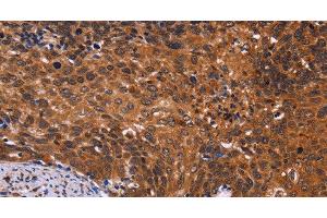 Immunohistochemistry of paraffin-embedded Human cervical cancer tissue using CDC5L Polyclonal Antibody at dilution 1:40 (CDC5L 抗体)