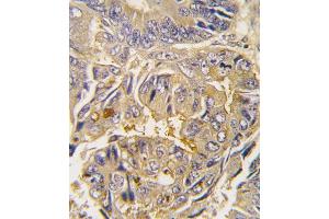 Formalin-fixed and paraffin-embedded human colon carcinoma tissue reacted with Autophagy G16L antibody , which was peroxidase-conjugated to the secondary antibody, followed by DAB staining. (ATG16L1 抗体  (AA 161-190))