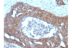 Formalin-fixed, paraffin-embedded human Ovarian Carcinoma stained with pS2 Mouse Monoclonal Antibody (GE2). (TFF1 抗体  (AA 57-84))