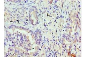 Immunohistochemistry of paraffin-embedded human lung cancer using ABIN7172874 at dilution of 1:100 (TRPM8 抗体  (AA 980-1104))