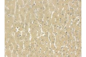 ABIN6261313 and ABIN6277179 at 1/100 staining human hepatocellular carcinoma by IHC-P. (DLGAP5 抗体  (N-Term))
