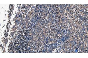 Detection of PECAM1 in Human Endometrial cancer Tissue using Polyclonal Antibody to Platelet/Endothelial Cell Adhesion Molecule (PECAM1) (CD31 抗体  (AA 199-287))