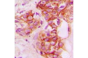 Immunohistochemical analysis of CD40 staining in human breast cancer formalin fixed paraffin embedded tissue section.
