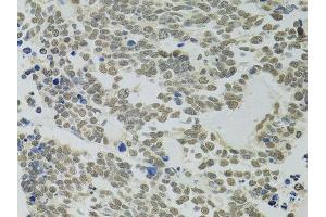 Immunohistochemistry of paraffin-embedded human lung cancer using PPP4C antibody. (PPP4C 抗体  (AA 1-307))