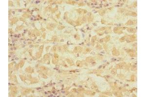 Immunohistochemistry of paraffin-embedded human gastric cancer using ABIN7149799 at dilution of 1:100 (DET1 抗体  (AA 15-240))