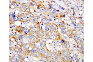 IHC-P: CXCL4 antibody testing of human lung cancer tissue (PF4 抗体  (AA 85-101))