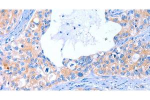 Immunohistochemistry of paraffin-embedded Human cervical cancer tissue using ARRB1 Polyclonal Antibody at dilution 1:50 (beta Arrestin 1 抗体)