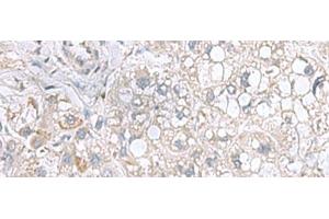 Immunohistochemistry of paraffin-embedded Human liver cancer tissue using STK32A Polyclonal Antibody at dilution of 1:95(x200) (STK32A 抗体)