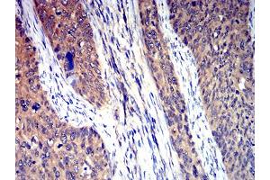 Immunohistochemical analysis of paraffin-embedded cervical cancer tissues using HTR3A mouse mAb with DAB staining. (Serotonin Receptor 3A 抗体  (AA 24-157))