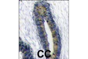 Formalin-fixed and paraffin-embedded human colon carcinoma reacted with FUBI Antibody , which was peroxidase-conjugated to the secondary antibody, followed by DAB staining. (FAU 抗体  (AA 60-93))