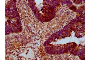 IHC image of ABIN7167248 diluted at 1:400 and staining in paraffin-embedded human ovarian cancer performed on a Leica BondTM system. (RAB21 抗体  (AA 141-222))
