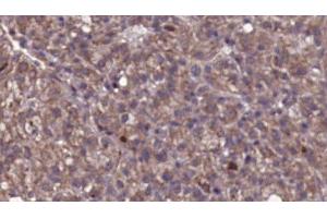 ABIN6276801 at 1/100 staining Human liver cancer tissue by IHC-P. (GRK2 抗体  (Internal Region))