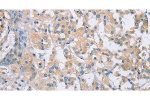 Immunohistochemistry of paraffin-embedded Human thyroid cancer using CDCP1 Polyclonal Antibody at dilution of 1:50 (CDCP1 抗体)