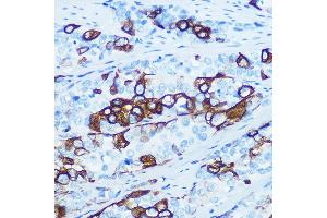 Immunohistochemistry of paraffin-embedded human esophageal cancer using Cytokeratin 5 (KRT5) (KRT5) Rabbit mAb (ABIN7268103) at dilution of 1:100 (40x lens). (Cytokeratin 5 抗体)